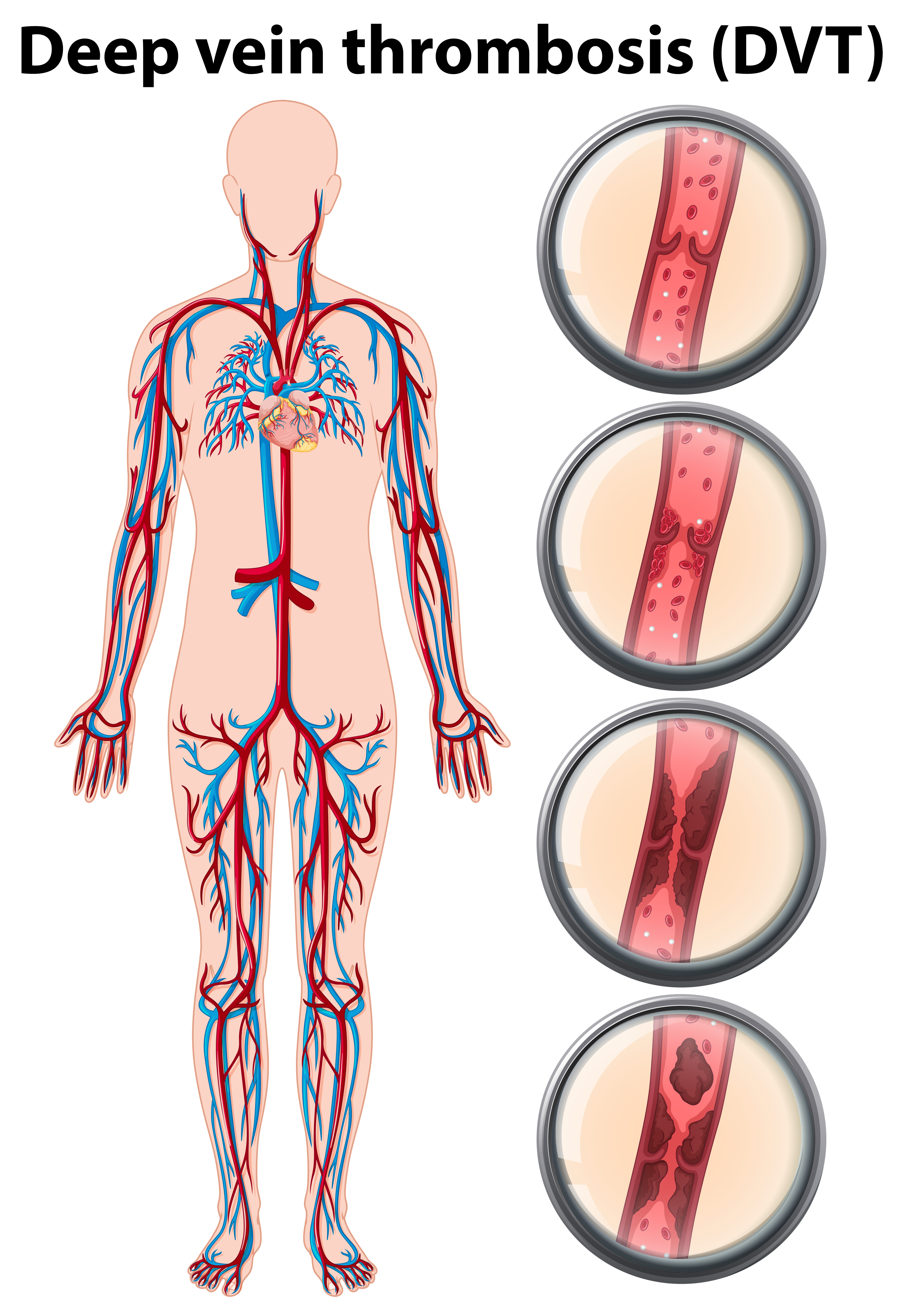Deep vein thrombosis anatomy