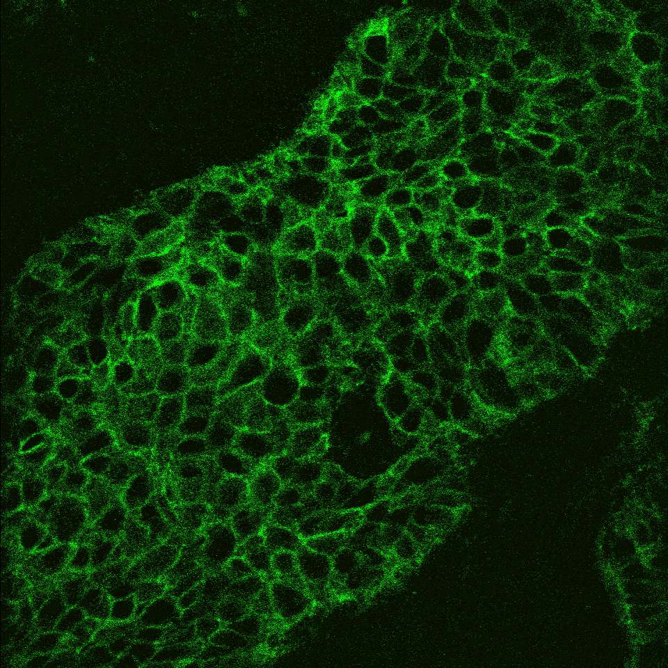 Schnell und präzise: Neuartiges Laser-Scanning-Mikroskop verbessert Erkennung von Tumorzellen Das Fluoreszenz-Bild eines Tumorschnitts, aufgenommen mit dem LSC-Onco-Mikroskop. Die grün fluoreszierende Fläche zeigt Krebszellen an.