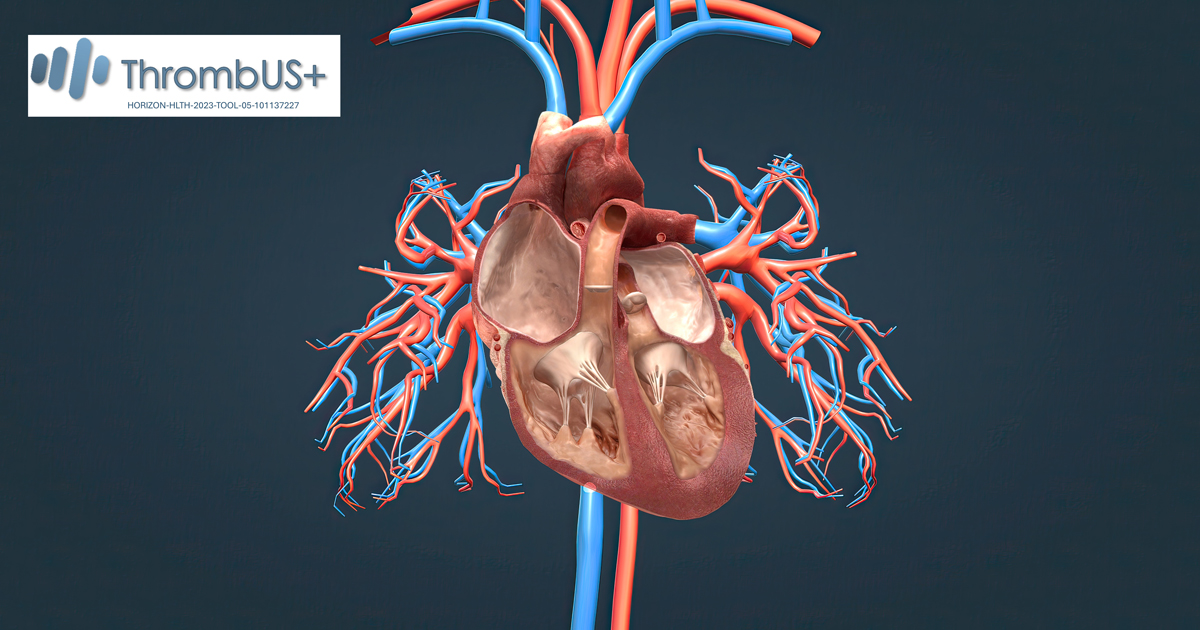 A pulmonary embolism is a blocked blood vessel in your lungs